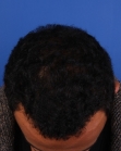 After Hair Transplant&nbsp;Front